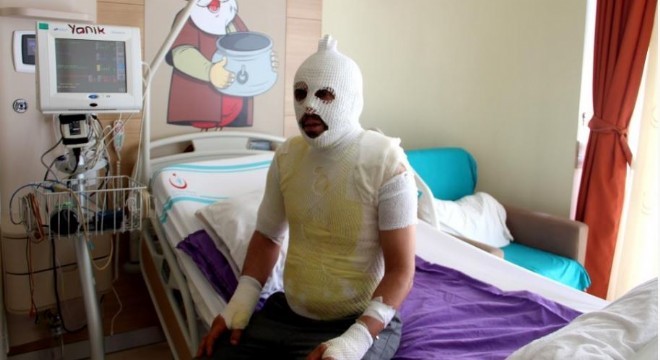 Akrabaları tarafından yakıldığını iddia etti